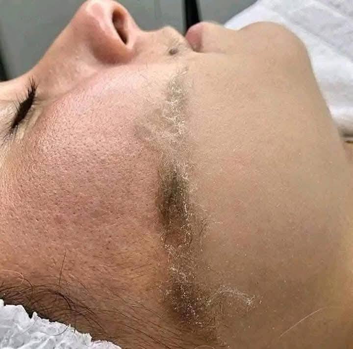 شفرات إزالة الشعر للوجه من ترينا للنساء دي ديرما بلانينج TRINA الأصلية – لبشرة ناعمة وصافية في دقائق - عبوة من قطعتين