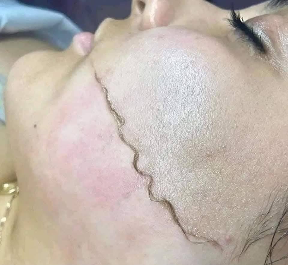 شفرات إزالة الشعر للوجه من ترينا للنساء دي ديرما بلانينج TRINA الأصلية – لبشرة ناعمة وصافية في دقائق - عبوة من قطعتين